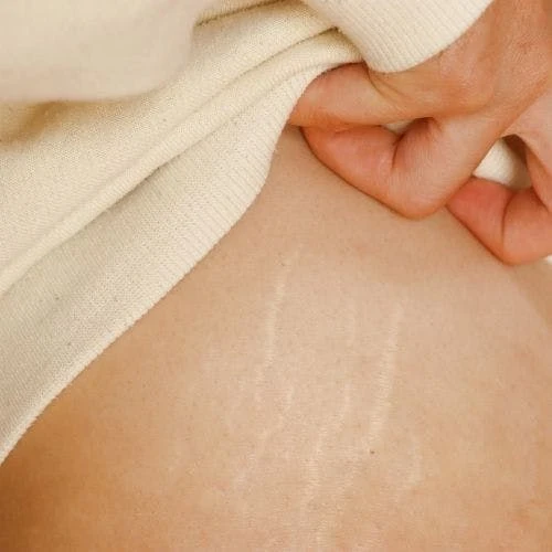 What are stretch marks?