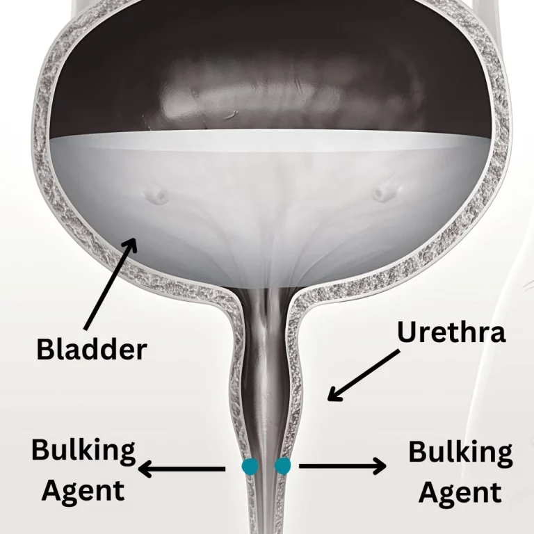 Urethral Bulking Agents For Urinary Incontinence
