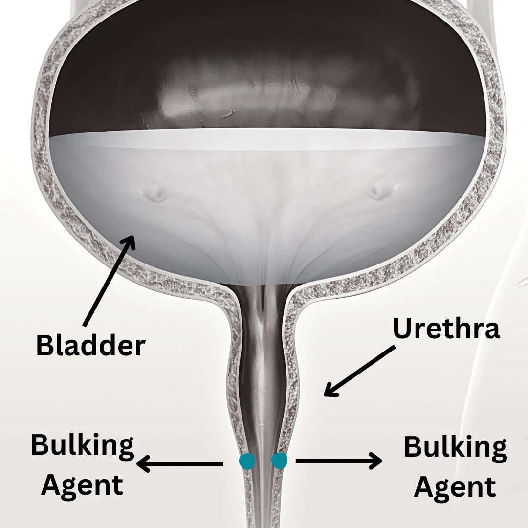 Urethral+Bulking+(2)