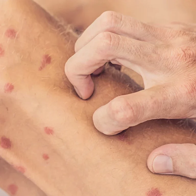 Itchy Red Spots On Skin – 7 Causes You Need To Know About