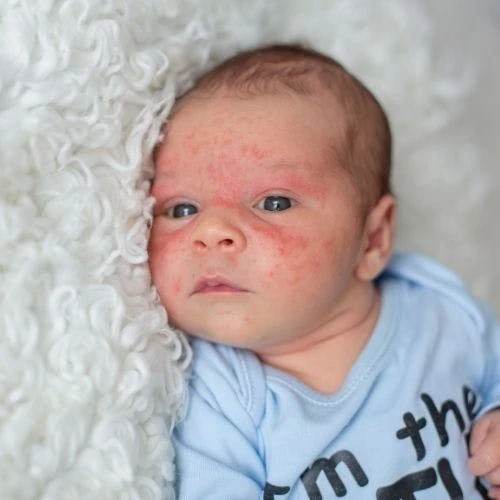 Infant Eczema: Baby Skin Care And Baby Diaper Rash Care