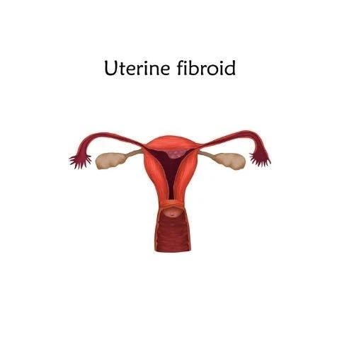 The Types of Fibroids You Should Be Aware Of